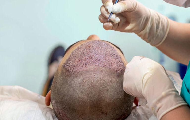 Bio-Enhanced-Hair-Transplant-Dubai